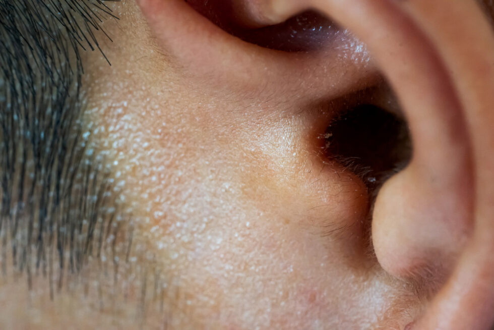 Ear Wax Removal Why It's Important and How to Do It Safely