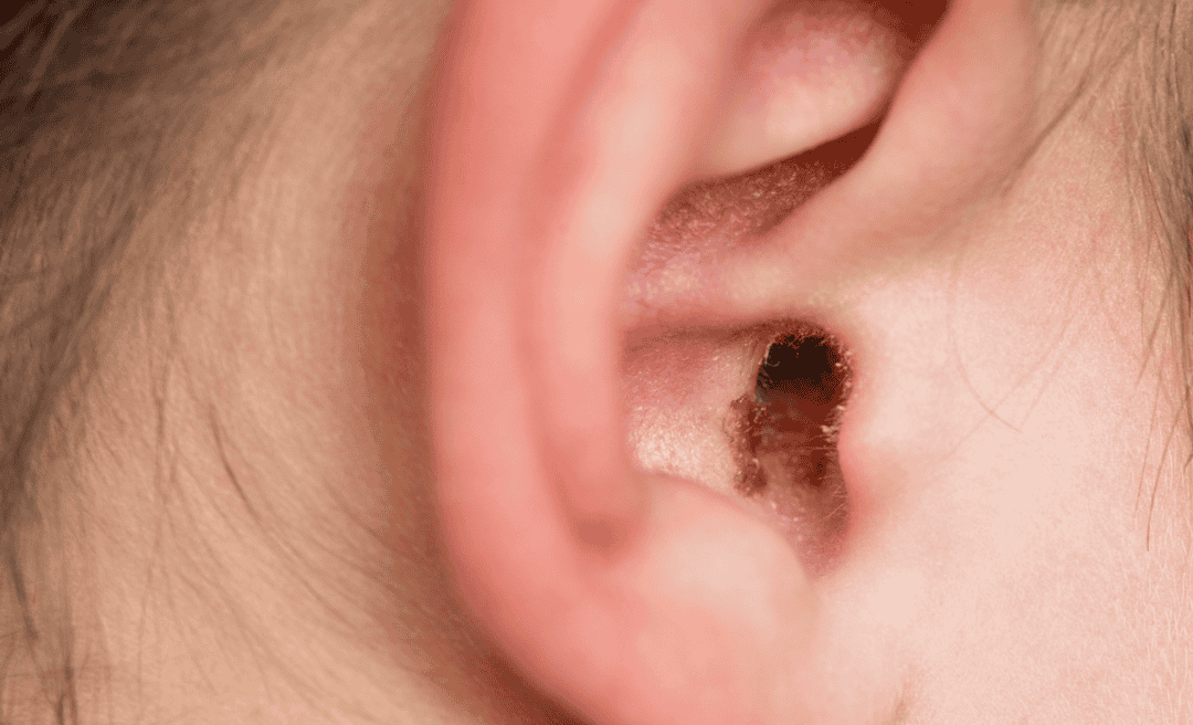 Why You Shouldn’t Ignore Excessive Earwax: Signs You Need Microsuction
