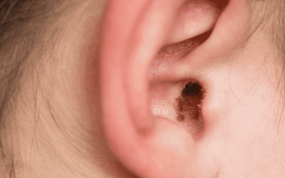 Why You Shouldn’t Ignore Excessive Earwax: Signs You Need Microsuction