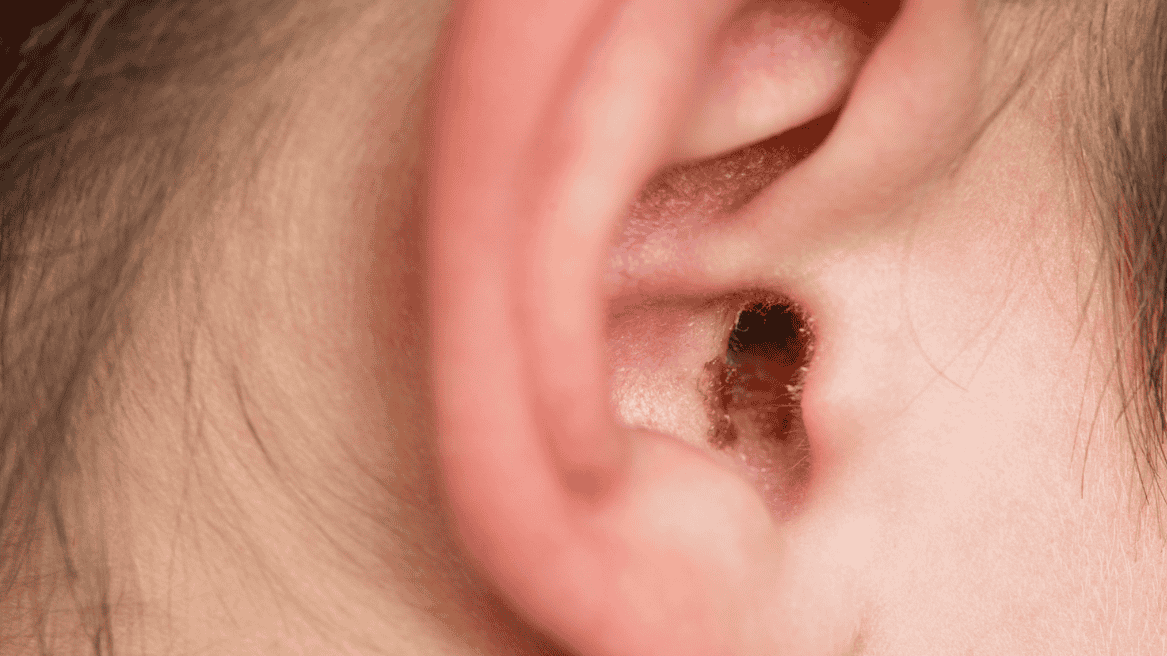 You Shouldn’t Ignore Excessive Earwax - Signs You Need Microsuction