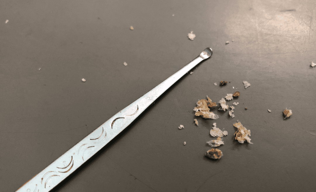 The Dangers of DIY Earwax Removal
