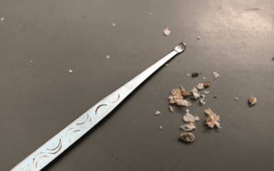 The Dangers of DIY Earwax Removal
