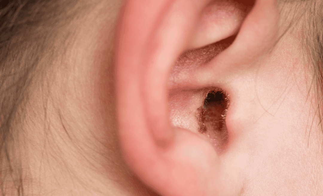 Microsuction Earwax Removal: The Safe, Modern Solution for Blocked Ears