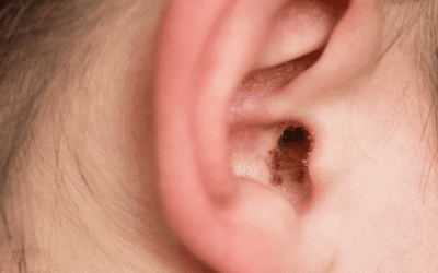 Microsuction Earwax Removal: The Safe, Modern Solution for Blocked Ears